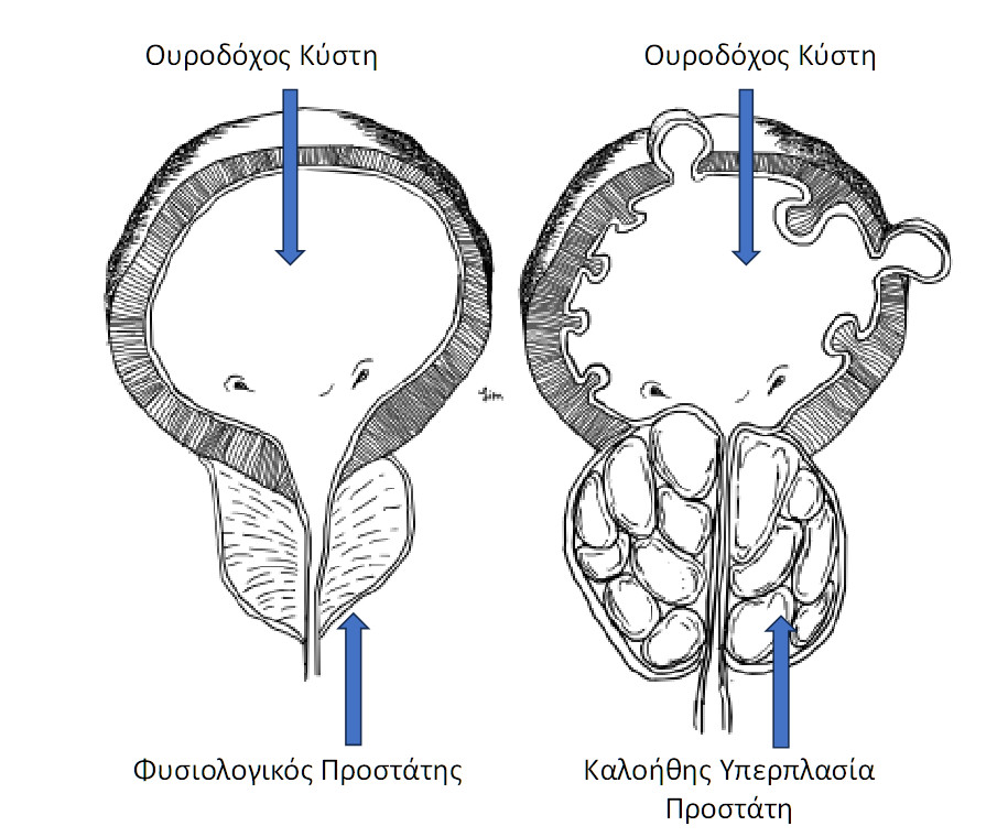 yperplasia-prostath